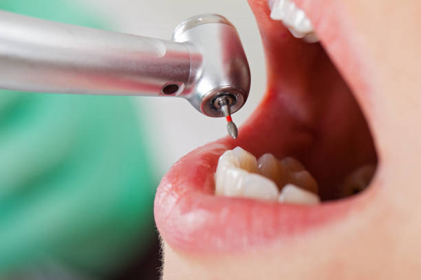 Best Emergency Tooth Extraction in New Haven, IN